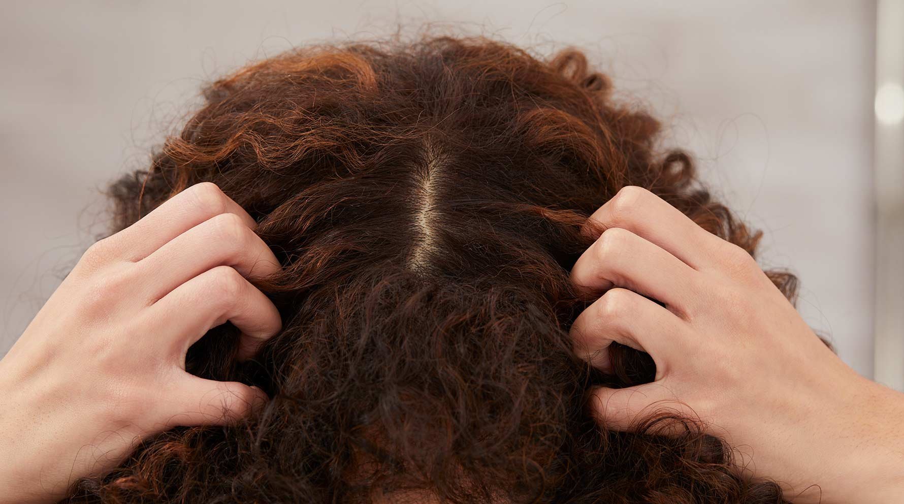 Itchy Scalp  Dandruff  Symptoms Causes Treatments Diagnosis